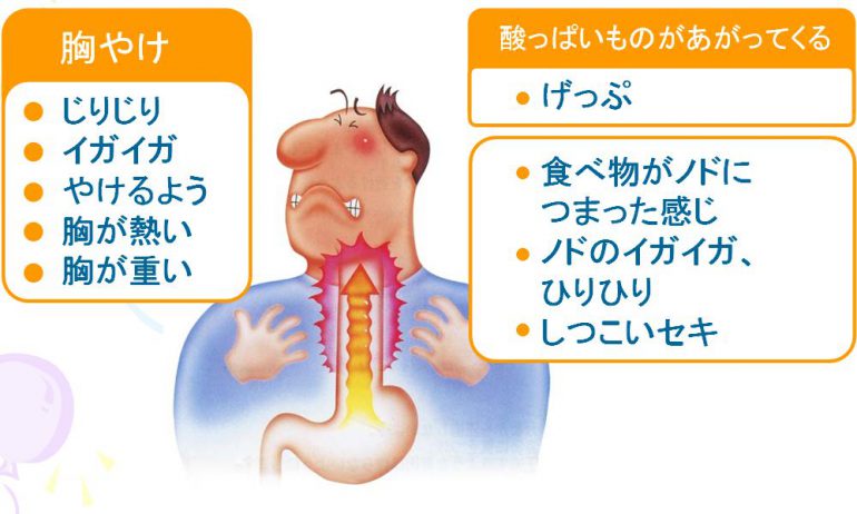 逆流 性 食道 炎 症状